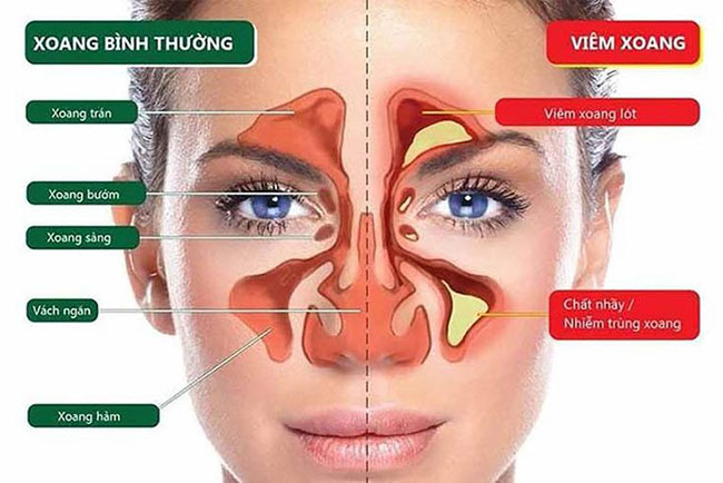 Top 5 cách giảm viêm xoang tại nhà hiệu quả