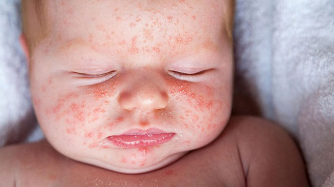 Chàm Sữa Ở Trẻ Sơ Sinh: Nguyên Nhân Và Cách Chữa Hiệu Quả