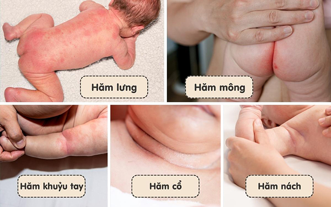 Hăm Da Ở Trẻ: Nguyên Nhân Và Cách Giảm Hăm Cho Bé